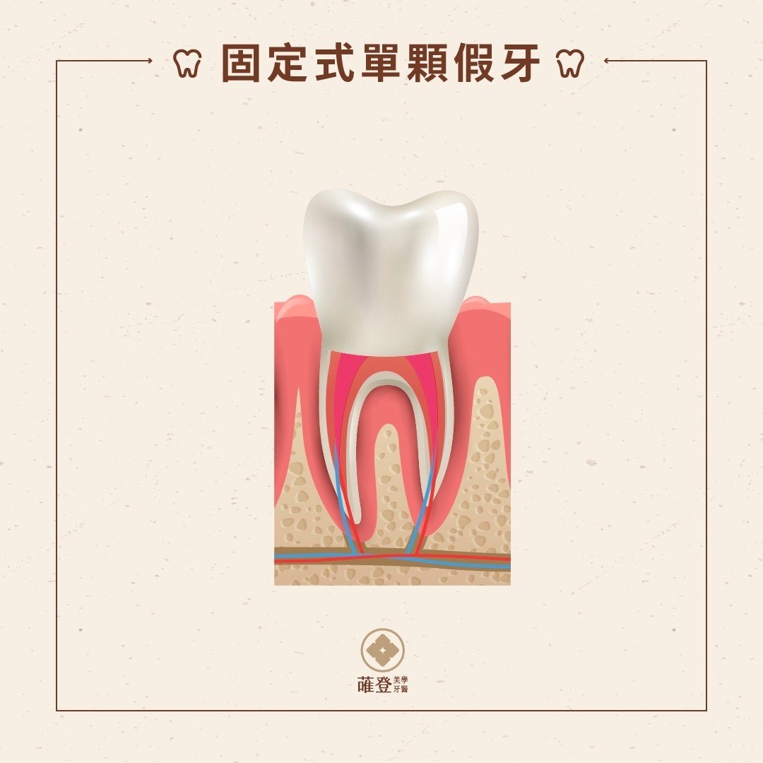 固定式單顆假牙