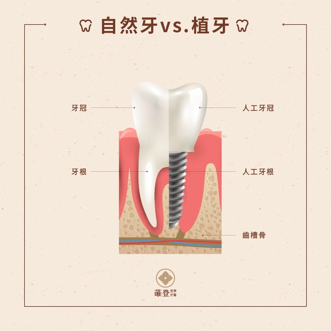 自然牙vs植牙