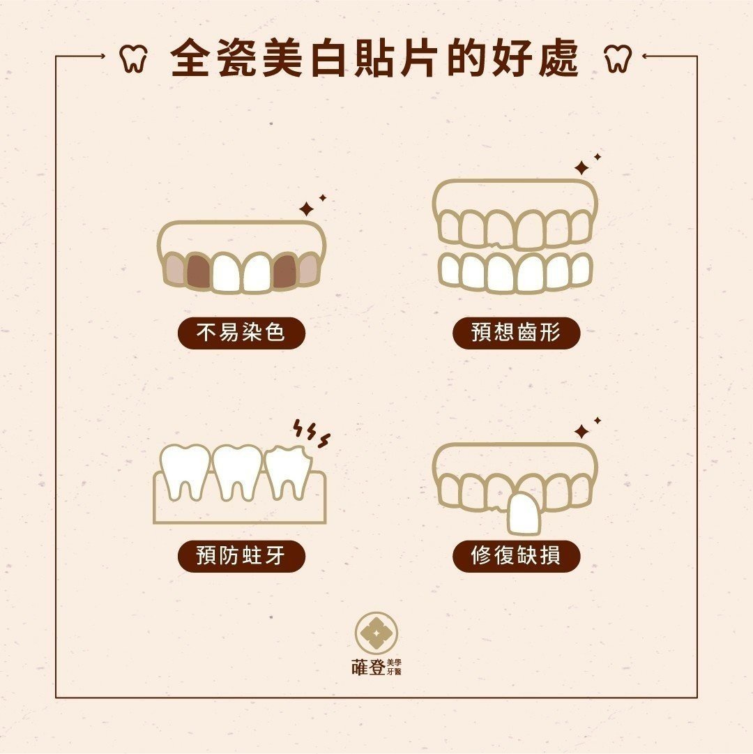 牙齒的微整形？全瓷貼片是什麼？讓美齒貼片專家告訴你！全瓷貼片的好處與優點！
